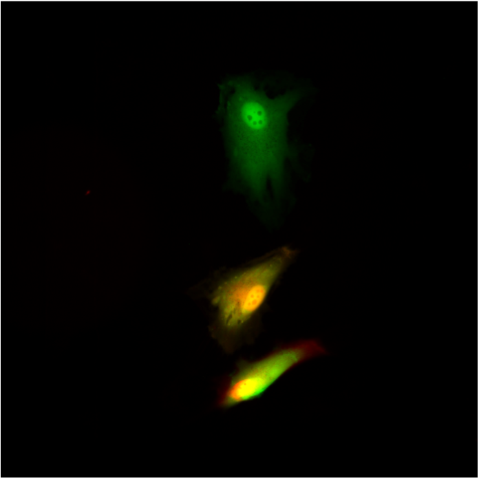 Glioblastoma cells that are transfected to express green fluorescent protein, but which have also been injected with a red fluorophore through nano-biopsy, thereby making them fluoresce yellow and red.
